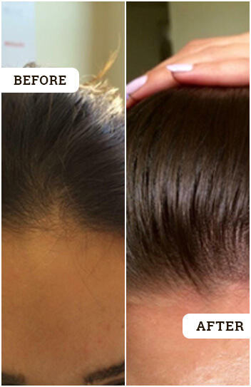 Hair Loss Treatment, Hair Regrowth Treatment
