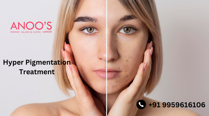 What is Pigmentation ? What are the treatments for pigmentation?