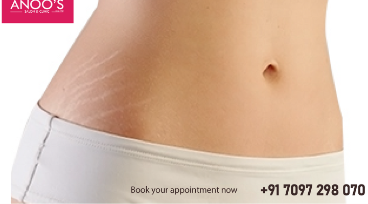 What are stretch marks ? What are the treatments available for stretch marks?