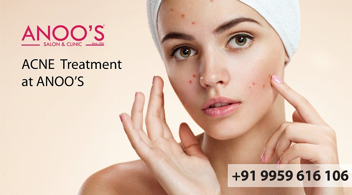 What are the causes for dry skin acne? What are the tips to reduce acne in dry skin? How can we treat dry skin acne?