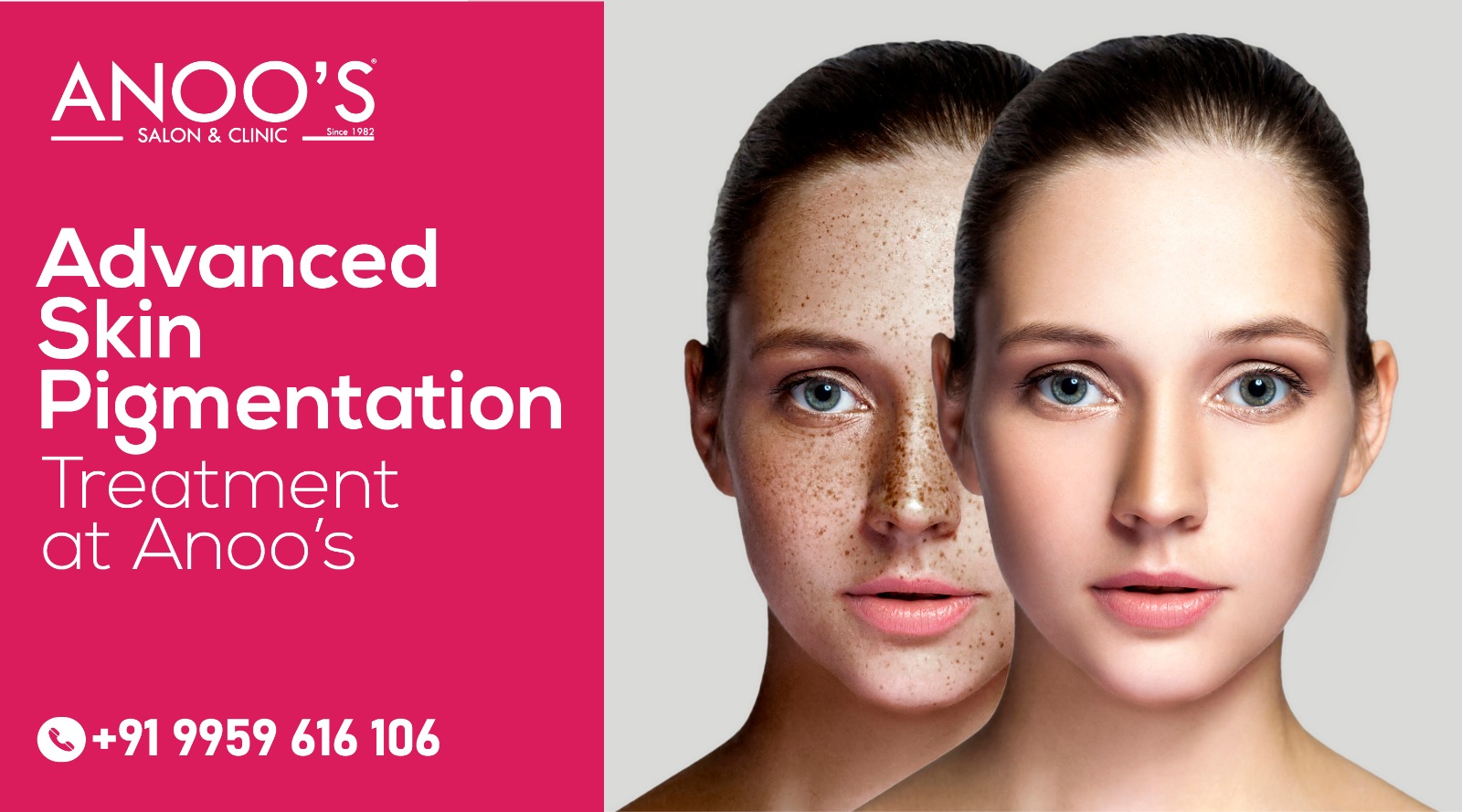 Pigmentation: Don’t Let It Get Under Your Skin!