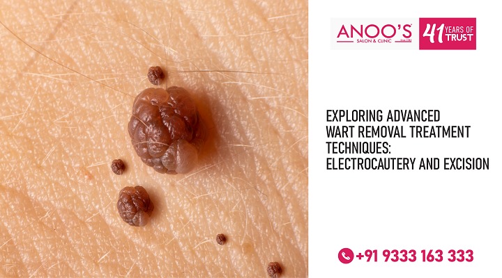 Exploring Advanced Wart Removal Treatment Techniques: Electrocautery and Excision
