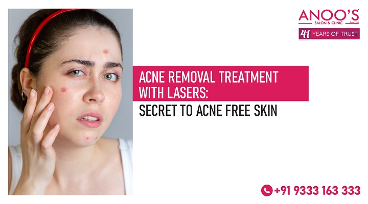 Acne Removal Treatment with Lasers – Secret to Acne Free Skin