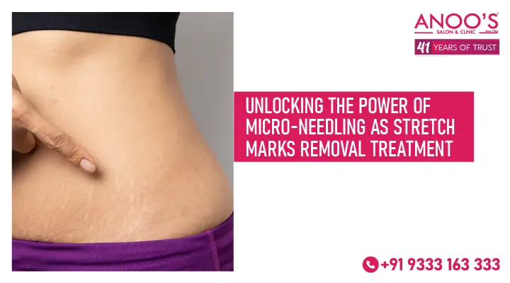 Unlocking the Power of Micro-Needling as Stretch Marks Removal Treatment
