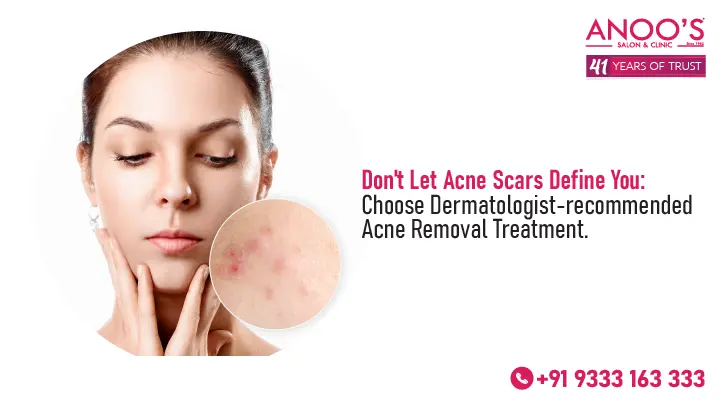 Don’t Let Acne Scars Define You: Choose Dermatologist-recommended Acne Removal Treatment.