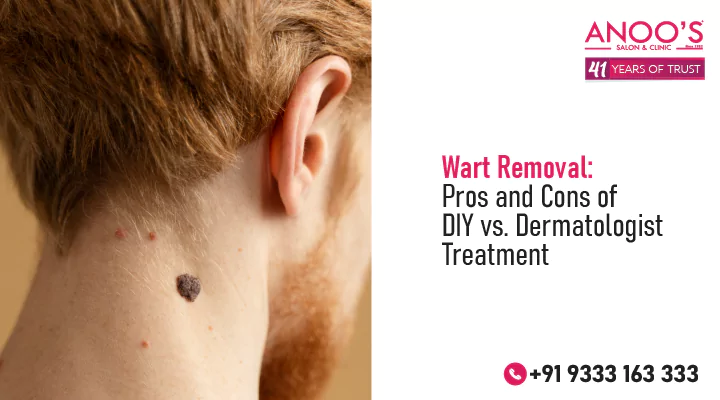 Wart Removal Treatment : Pros and Cons of DIY vs. Dermatologist Treatment
