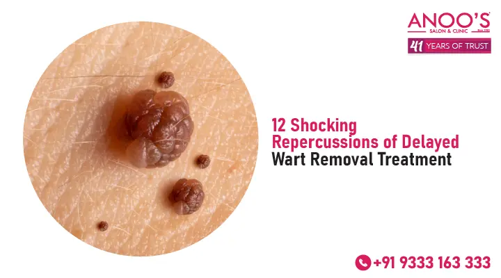 12 Shocking Repercussions of Delayed Wart Removal Treatment