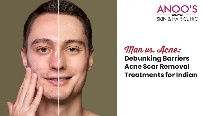 Man vs. Acne: Debunking Barriers Acne Scar Removal Treatments for Indian