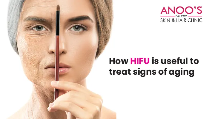 How HIFU is useful to treat signs of aging
