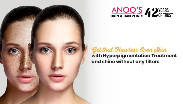 Get that Flawless Even Skin with Hyperpigmentation Treatment and shine without any filters.