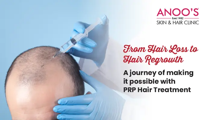 From Hair Loss to Hair Regrowth – A journey of making it possible with PRP Treatment