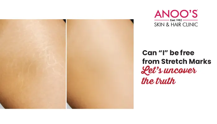 Can “I” be free from Stretch Marks – Let’s uncover the truth behind Stretch marks treatments