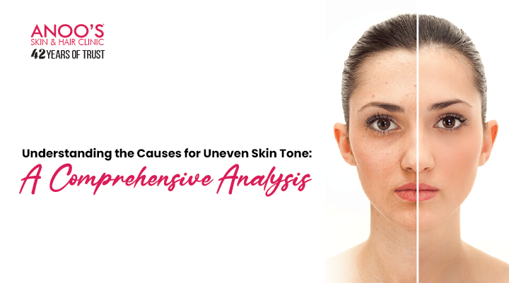 Understanding the Causes for Uneven Skin Tone: A Comprehensive Analysis