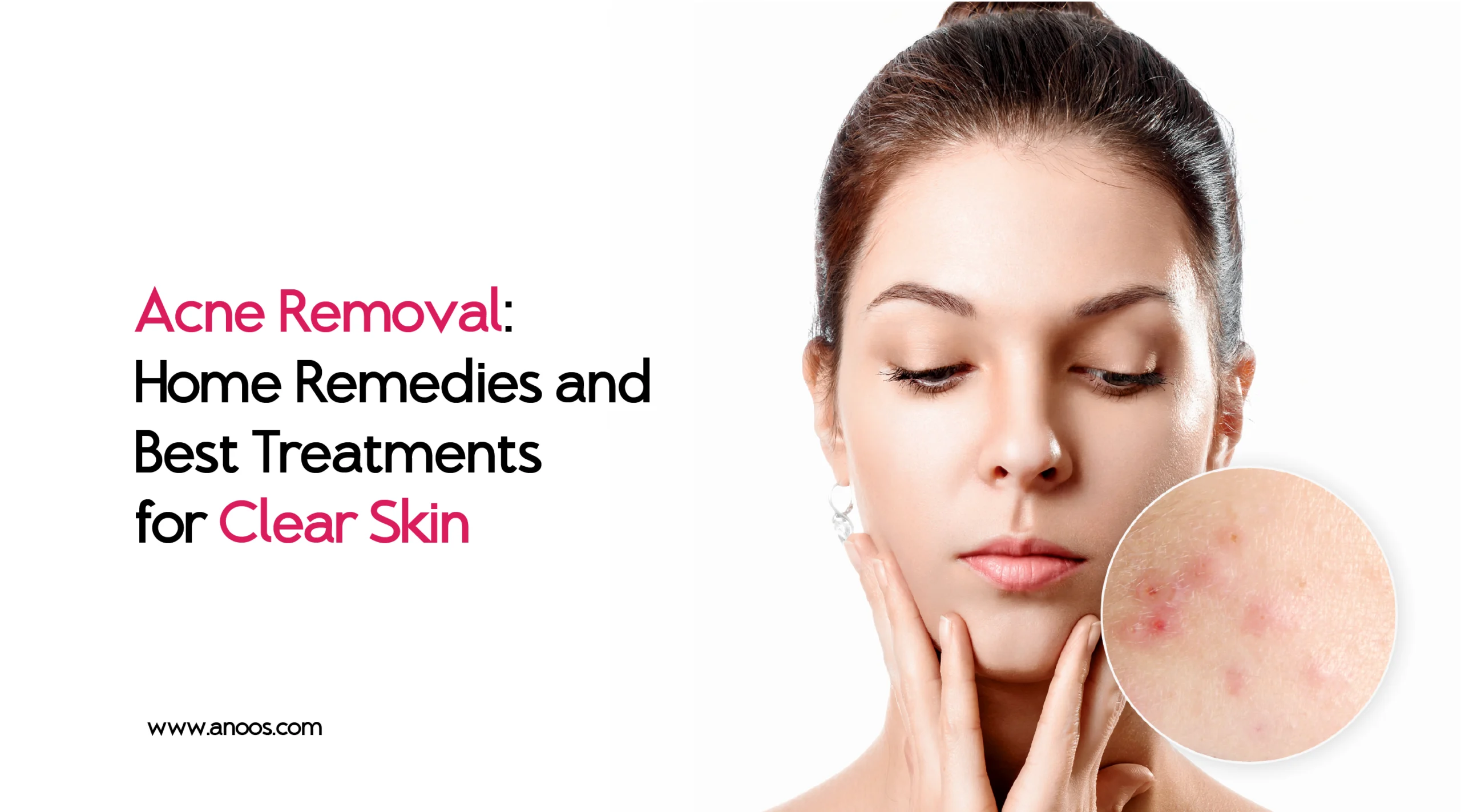 Acne Removal: Home Remedies and Best Treatments for Clear Skin