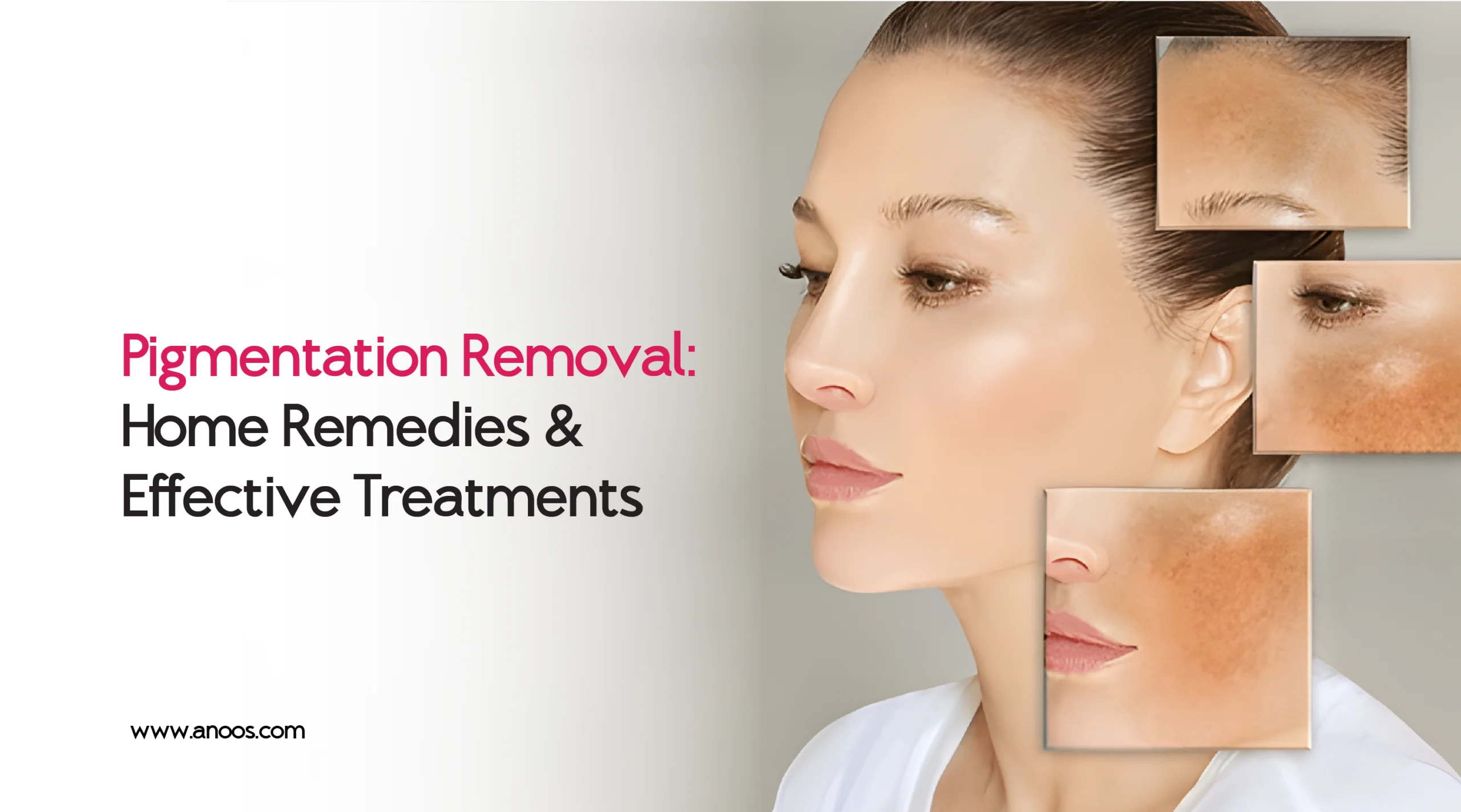 Pigmentation Removal: Home Remedies & Effective Treatments