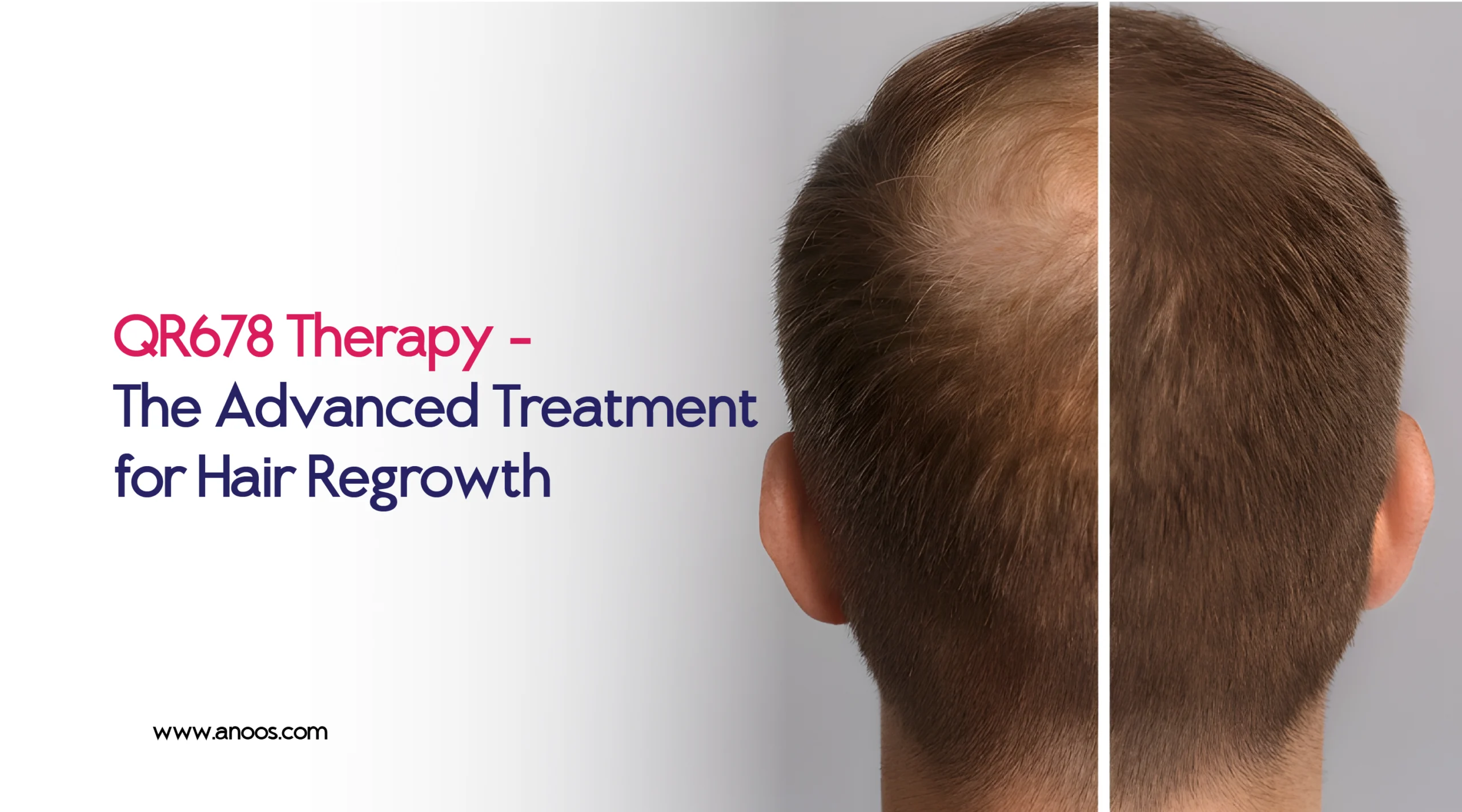 QR678 Therapy – The Advanced Treatment for Hair Regrowth