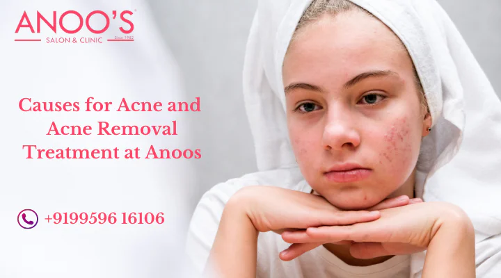 What are the causes for Acne ? Treatment for Acne Removal at Anoos