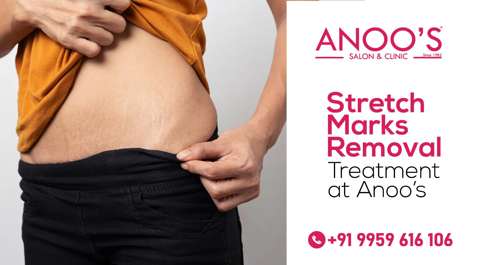 Stretch Marks Be Gone: Effective DIY Treatments and Professional Options | Anoos