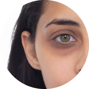 Under Eye Dark Circles