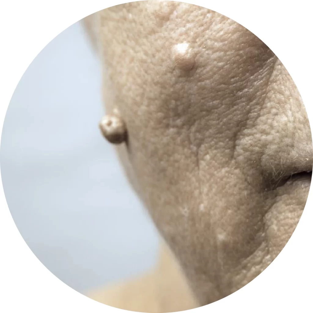 Warts