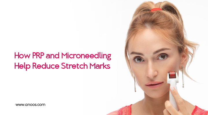 Stretch Marks