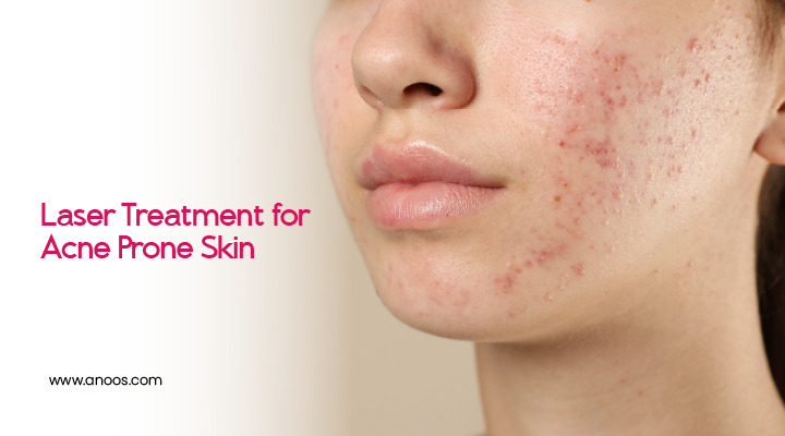 acne removal treatment