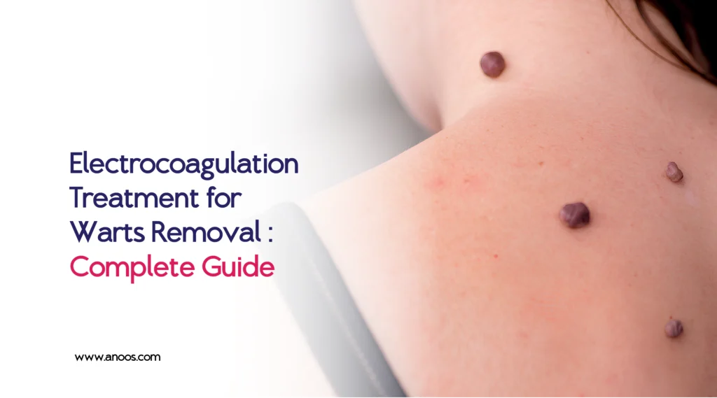 Electrocoagulation Treatment