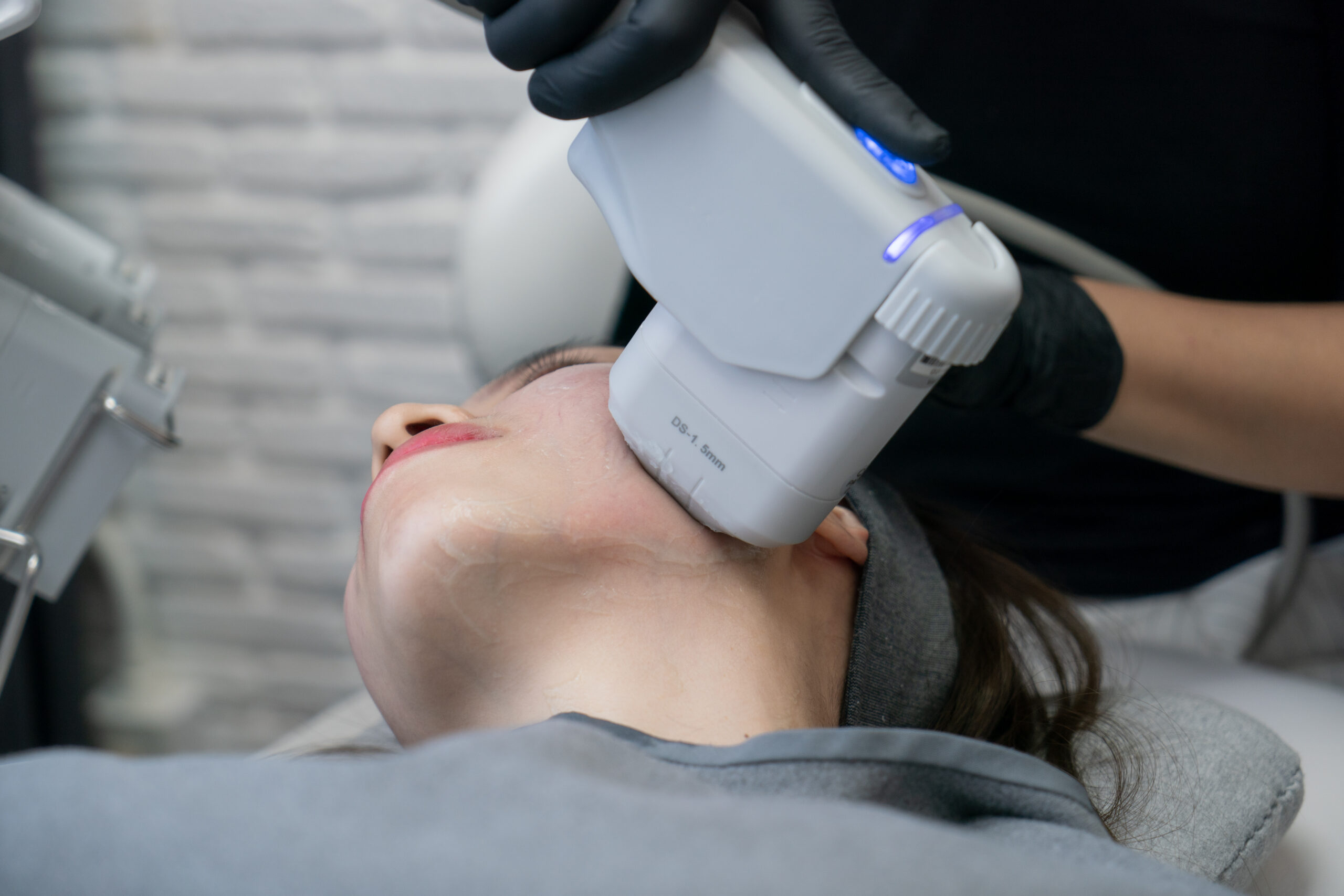 HIFU treatment
